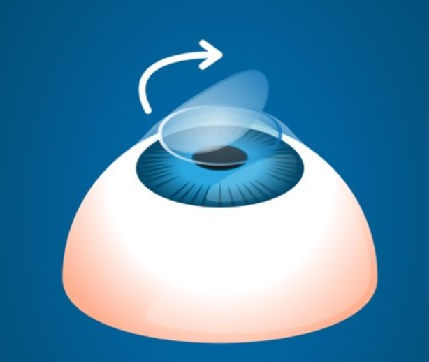Mengenal LASIK Mata sebagai Solusi Modern untuk Penglihatan Lebih Nyaman